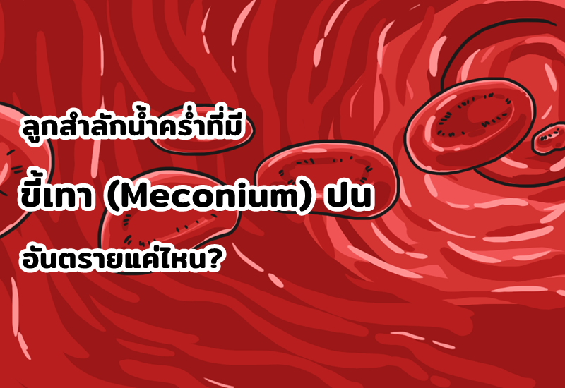 ลูกสำลักน้ำคร่ำที่มีขี้เทา (Meconium) ปน อันตรายแค่ไหน?
