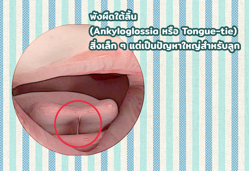 พังผืดใต้ลิ้น (Ankyloglossia หรือ Tongue-tie) สิ่งเล็ก ๆ แต่เป็นปัญหาใหญ่สำหรับลูก