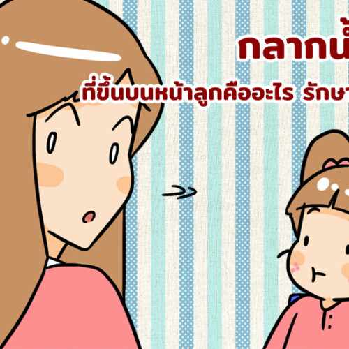 กลากน้ำนม ที่ขึ้นบนหน้าลูกคืออะไร รักษาได้ไหม